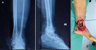 Simultaneous reconstruction of septic composite defects in lower extremities: Combination of fasciocutaneous perforator flap and Masquelet technique